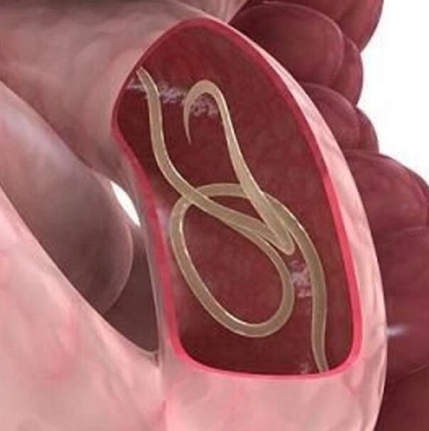 Semne de viermi la o persoană din tractul gastrointestinal